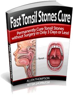 Fast Tonsil Stones Cure By Allen Thompson - eBook PDF Program